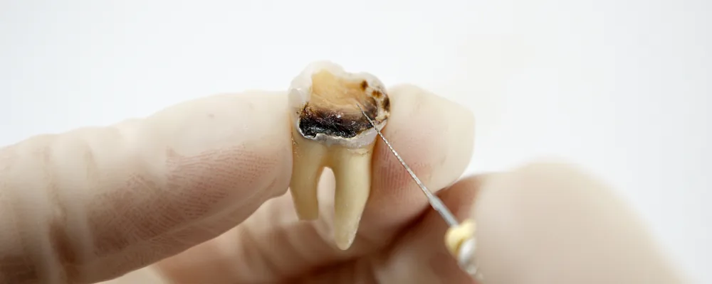 虫歯が進行して抜いた歯の断面と歯科用の器具｜戸塚モディシティデンタルクリニック