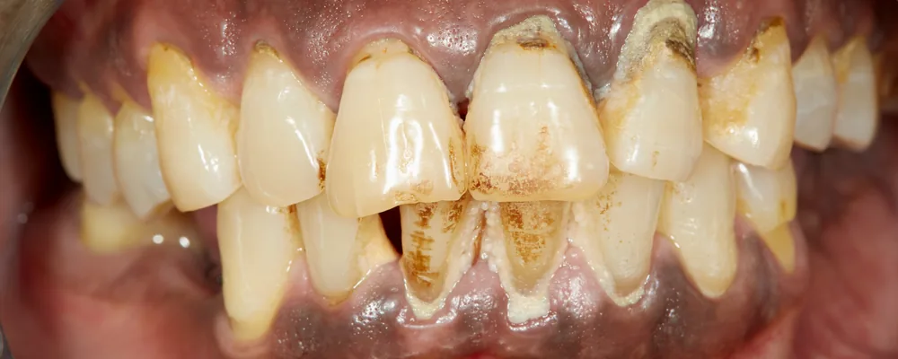 歯ぐきが下がって歯の根元が見えている口腔内の写真｜戸塚モディシティデンタルクリニック